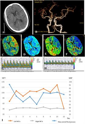 Cerebral Hemodynamic Evaluation After Cerebral Recanalization Therapy for Acute Ischemic Stroke